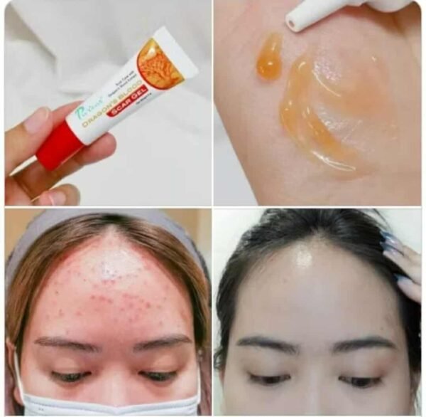 Puricas Natural Dragon's Blood Scar Gel Treat Keloid Surgery Acne Scars 9g - Image 5