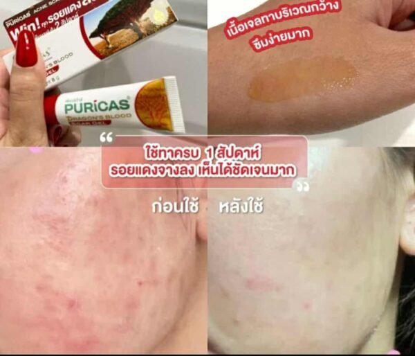 Puricas Natural Dragon's Blood Scar Gel Treat Keloid Surgery Acne Scars 9g - Image 6