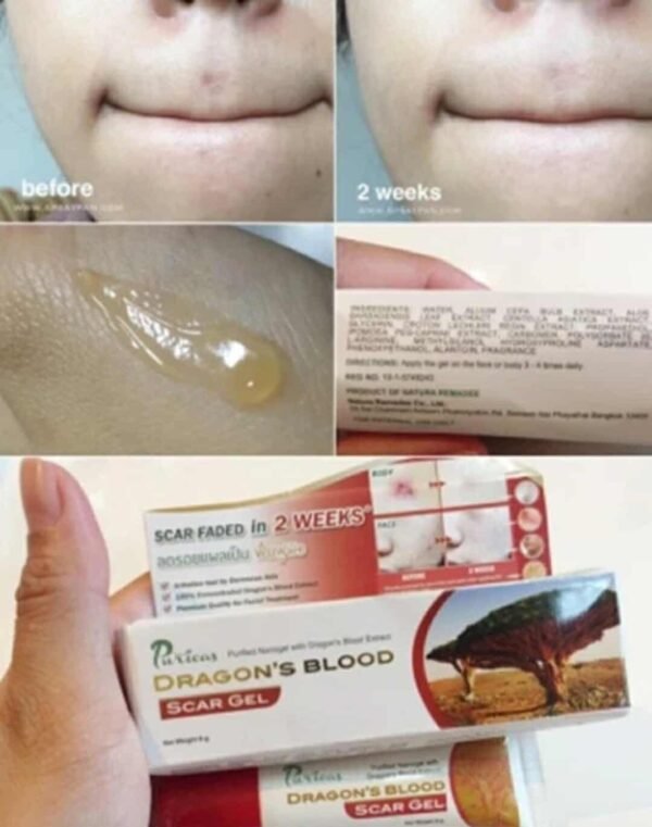 Puricas Natural Dragon's Blood Scar Gel Treat Keloid Surgery Acne Scars 9g - Image 7