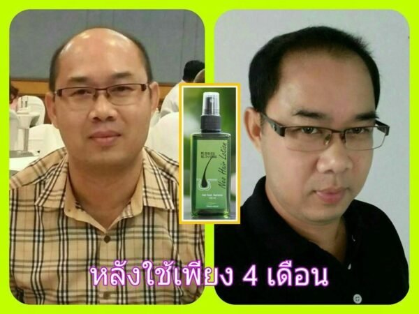 Neo hair Hair lotion for hair loss hair growth - Image 3