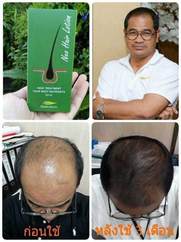 Neo hair Hair lotion for hair loss hair growth - Image 4
