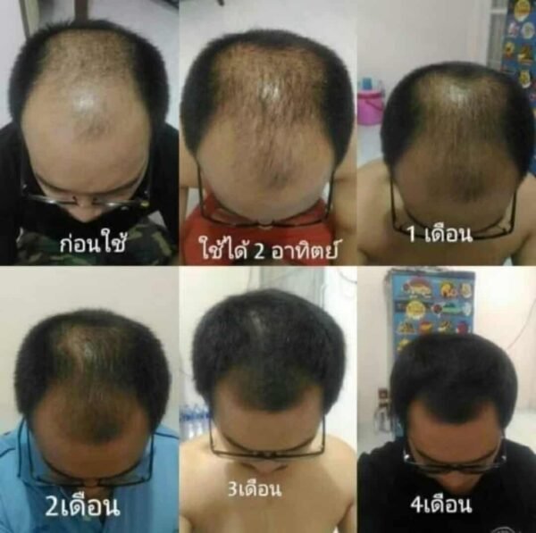 Neo hair Hair lotion for hair loss hair growth - Image 5