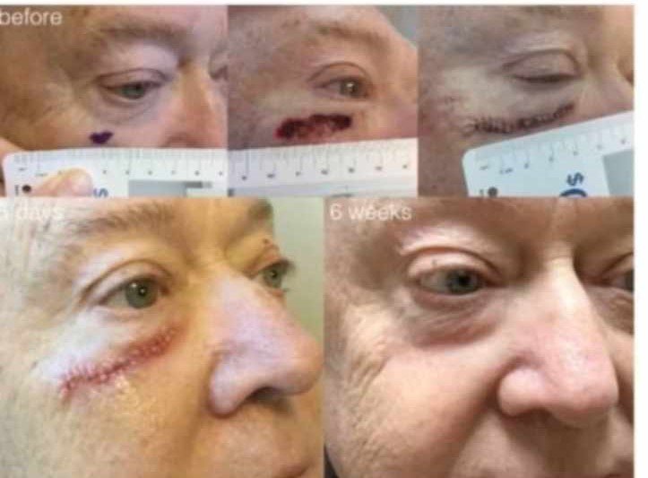 Post Procedure Hydrogel Dermodacyn for scar 15g - Image 2